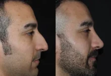 Nose Job in Dubai