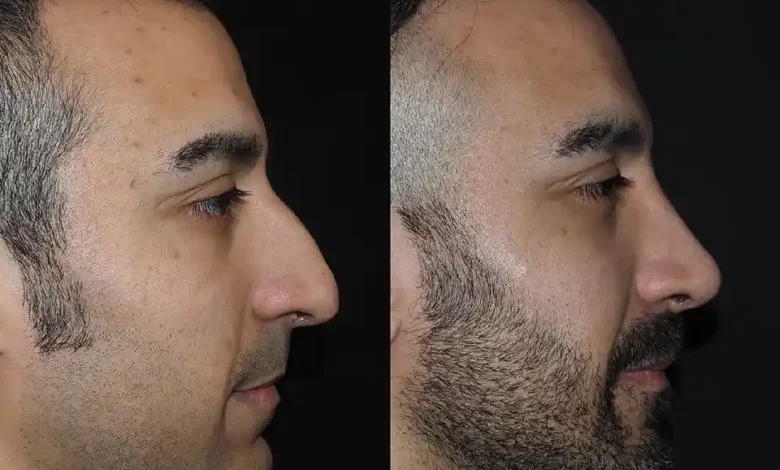 Nose Job in Dubai