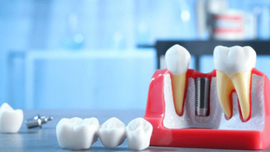 Innovative Strategies for Optimising Dental Implant Success