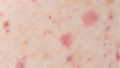mpox or monkeypox