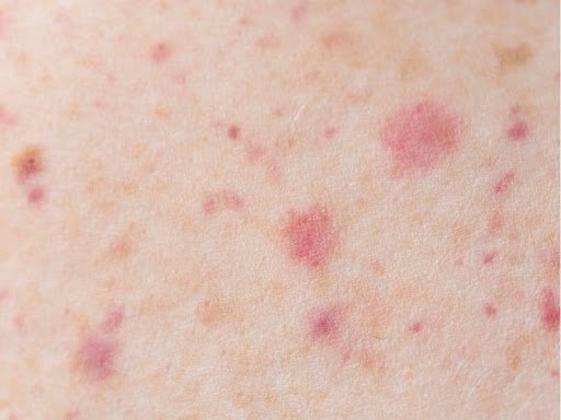 mpox or monkeypox